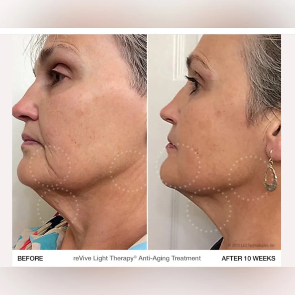 reVive‎ Glo Wrinkle Treatment Device
